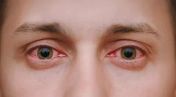 علامات ظهورها وطرق التعامل معها.webp