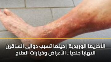 alakzyma alwrydyh hynma tsbb dwaly alsaqyn althaba jldya. alaarad wkhyarat alalaj
